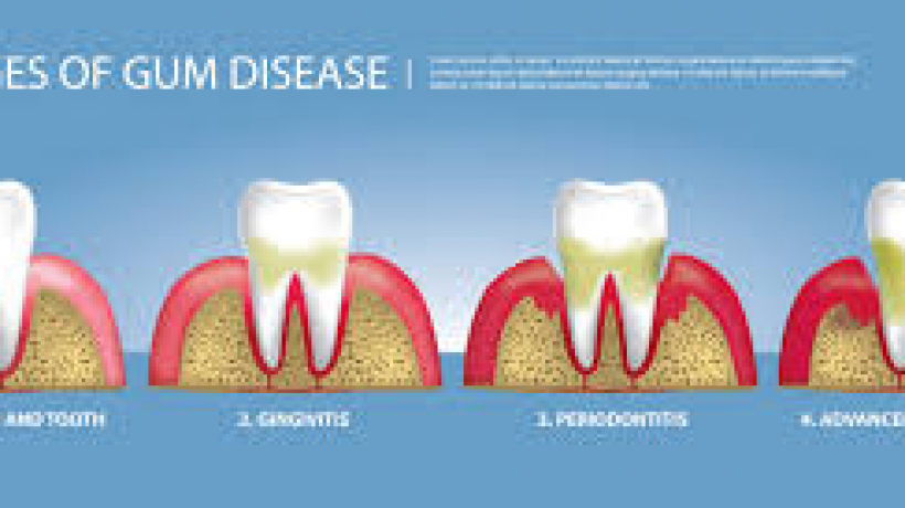 How to Stop Bleeding Gums